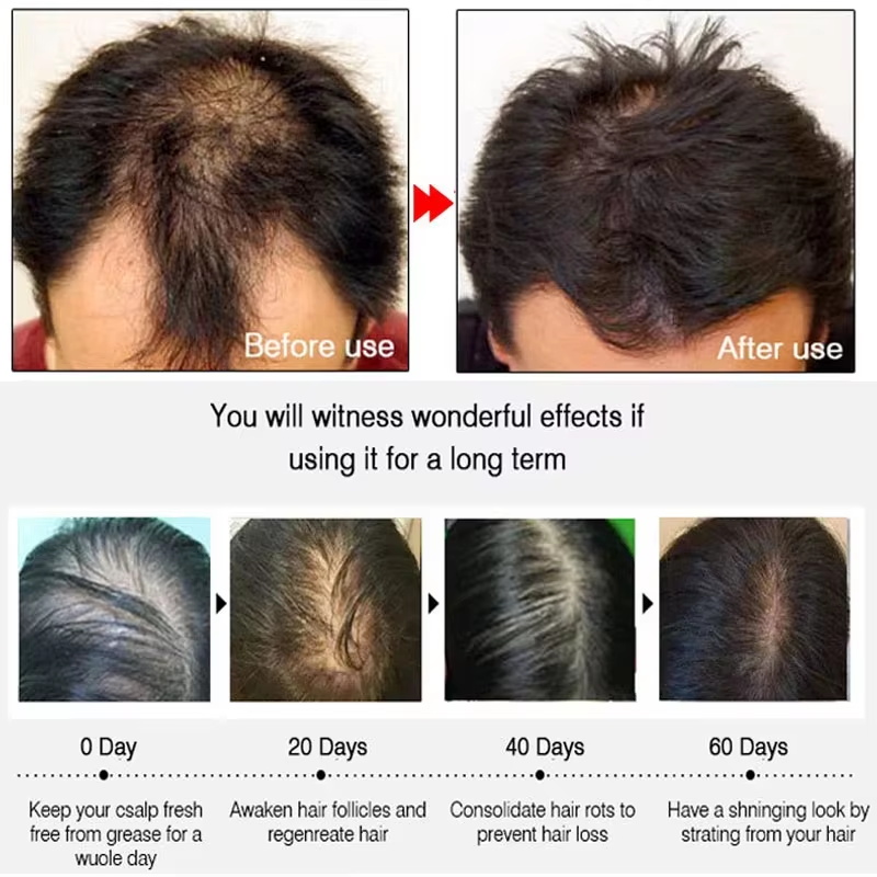 สเปรย์เร่งผมยาวขึ้นอย่างรวดเร็ - Hair Growth Serum Oil บทวิจารณ์และราคา